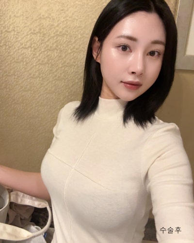 벌어진 새가슴체형 가슴골 만들기 가슴성형 전후 사진 7