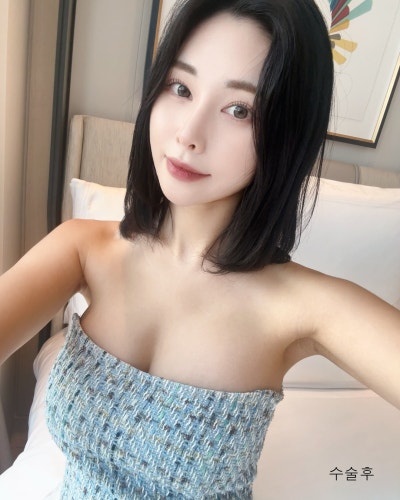 벌어진 새가슴체형 가슴골 만들기 가슴성형 전후 사진 3