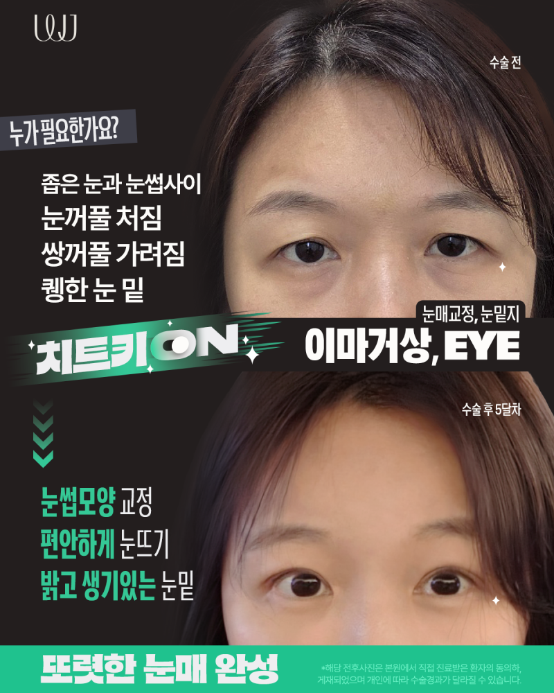 이마거상, 눈매교정, 눈밑지방재배치, 엘꿈리프팅 전후와 회복과정 사진 3