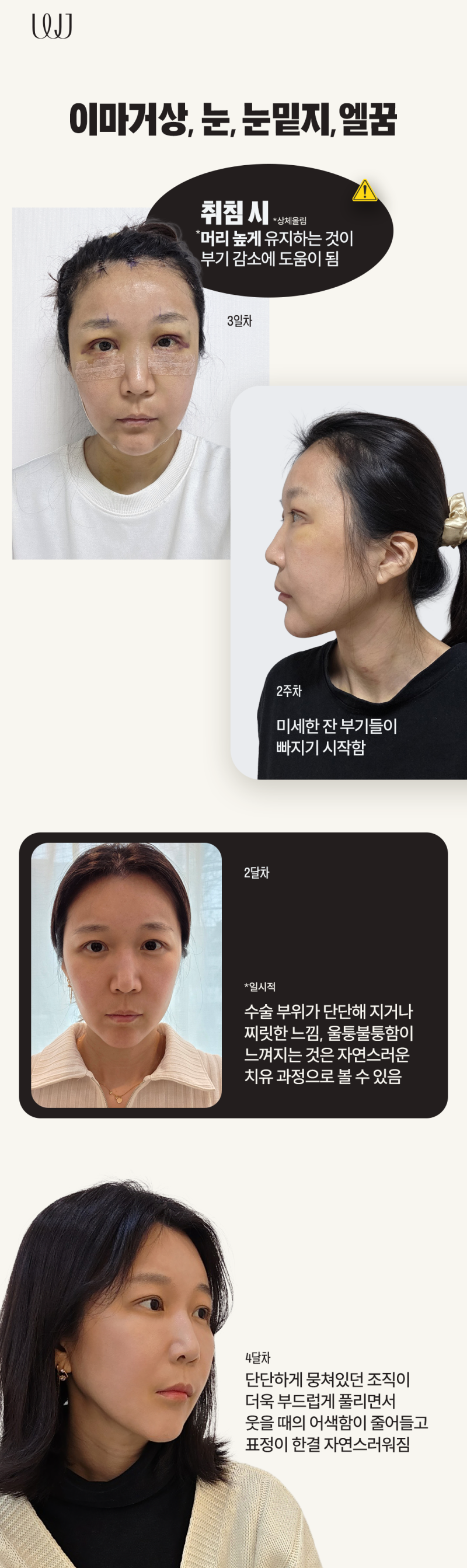이마거상, 눈매교정, 눈밑지방재배치, 엘꿈리프팅 전후와 회복과정 사진 5
