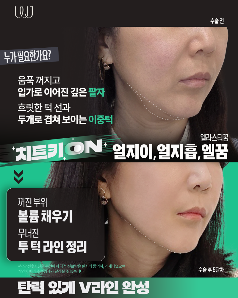 이마거상, 눈매교정, 눈밑지방재배치, 엘꿈리프팅 전후와 회복과정 사진 4