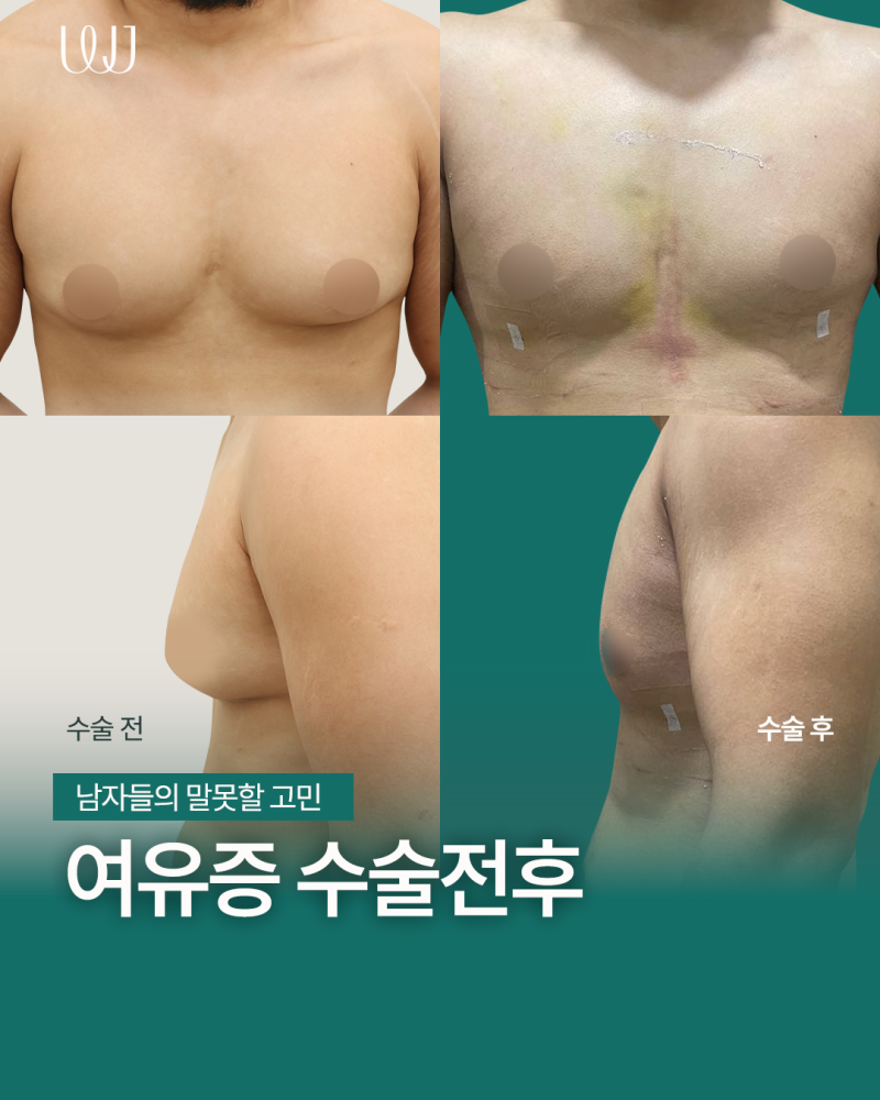 운동으로 해결 되지 않는 여유증 원인과 수술방법