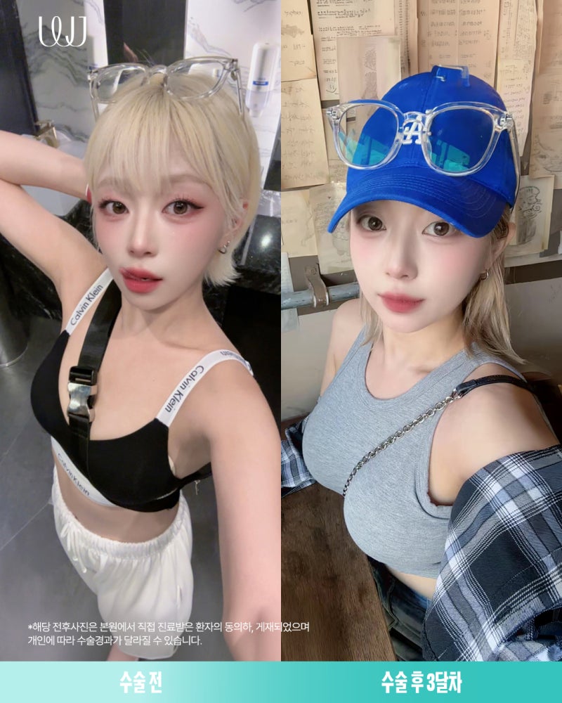 멘토엑스트라 가슴성형 전후와 회복과정 사진 6