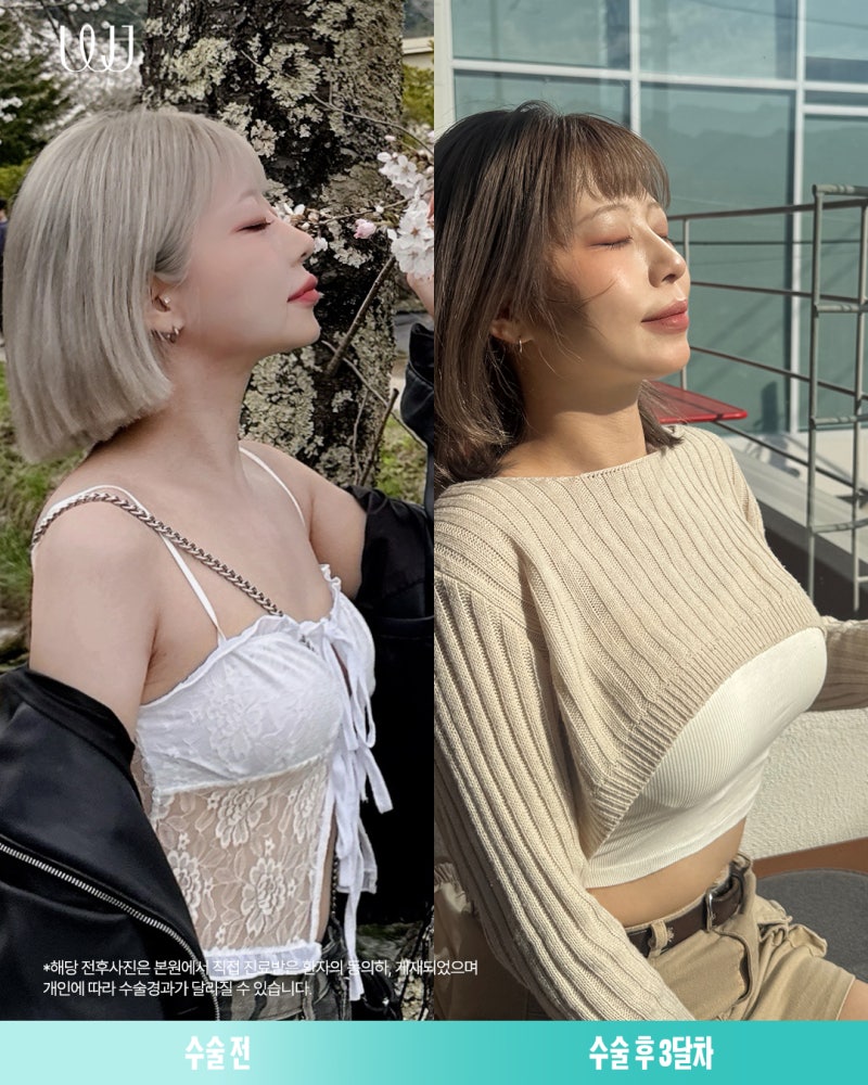 멘토엑스트라 가슴성형 전후와 회복과정 사진 7