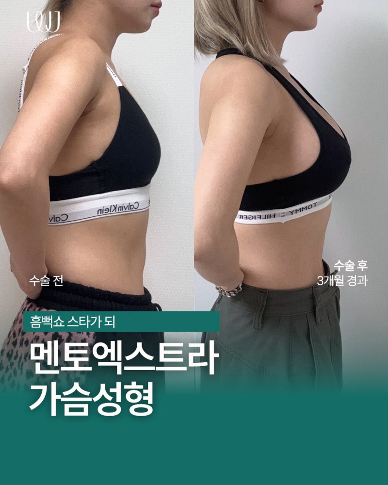 멘토엑스트라 가슴성형 전후와 회복과정