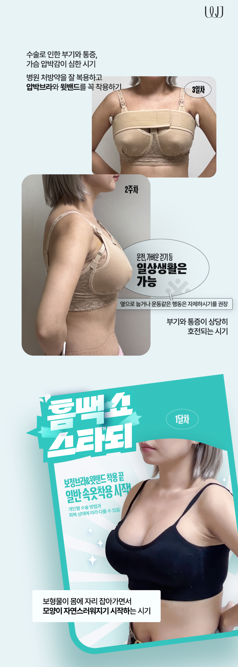멘토엑스트라 가슴성형 전후와 회복과정 사진 3