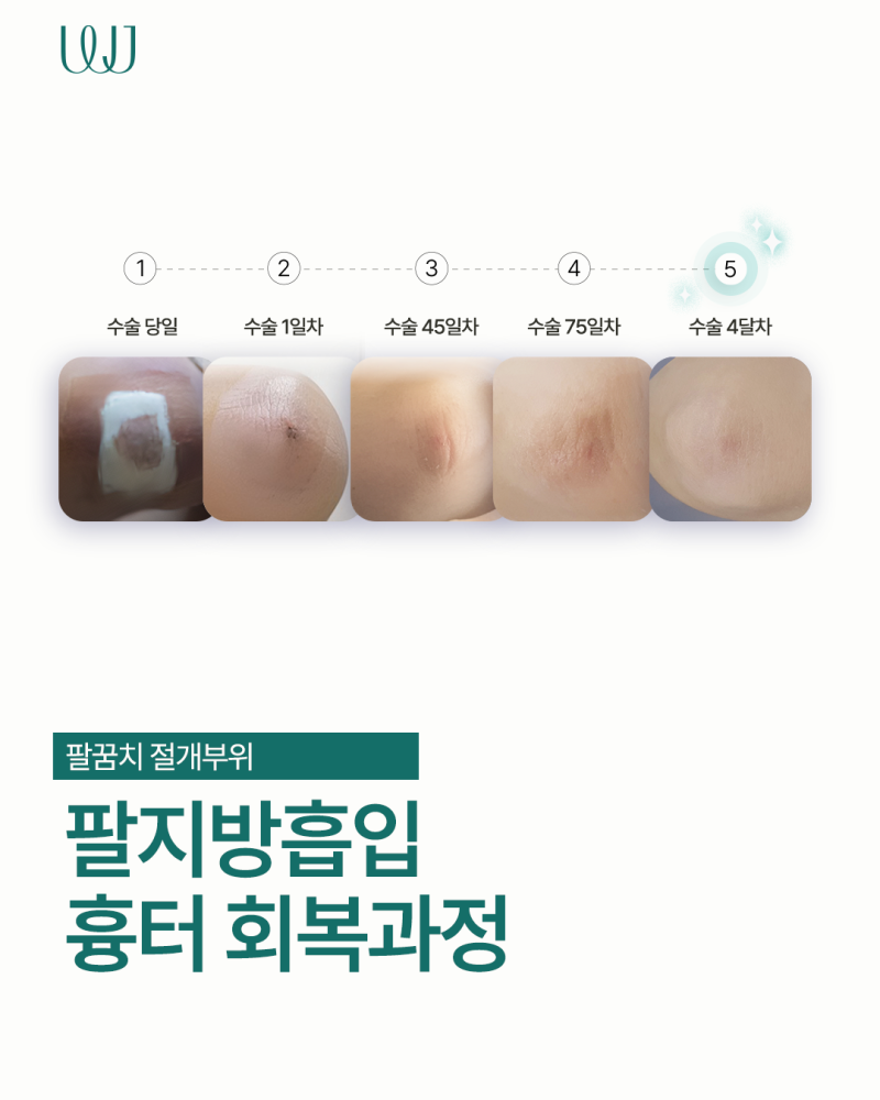 팔지방흡입 전후와 흉터회복과정 사진 6
