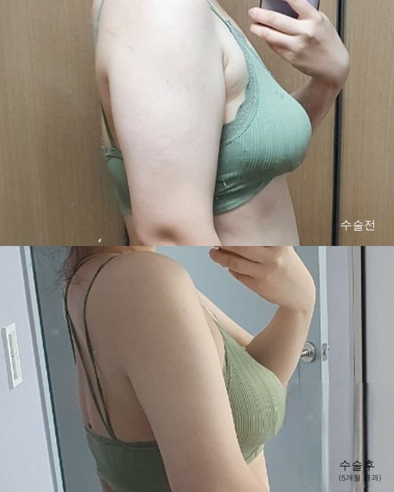 팔지방흡입 전후와 흉터회복과정 사진 5