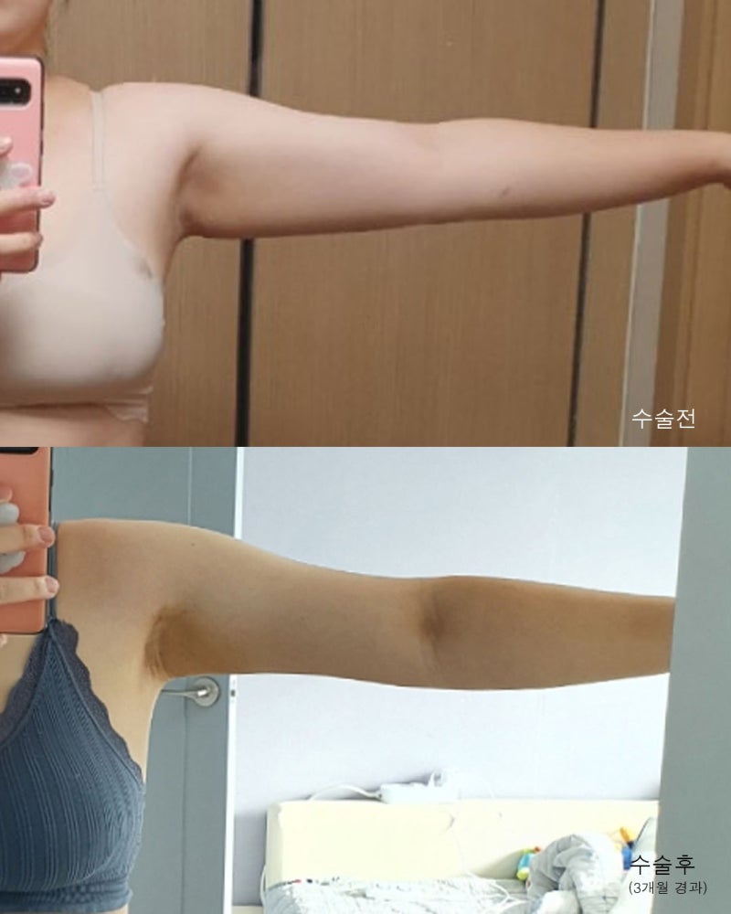 팔지방흡입 전후와 흉터회복과정 사진 4
