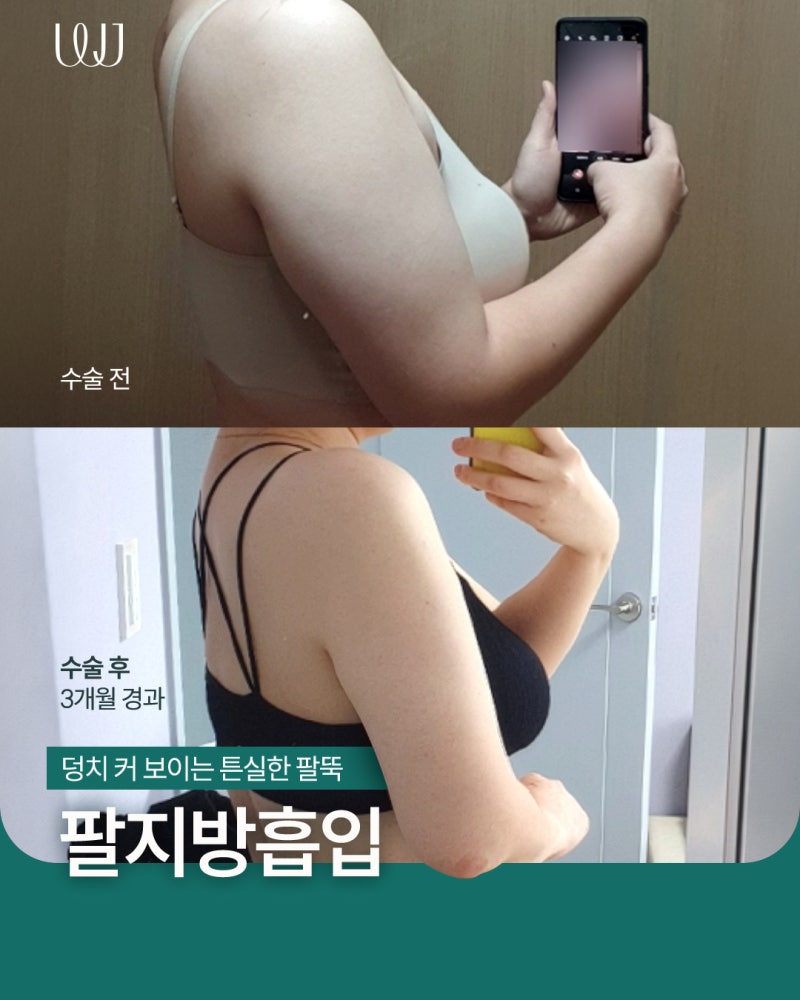 팔지방흡입 전후와 흉터회복과정