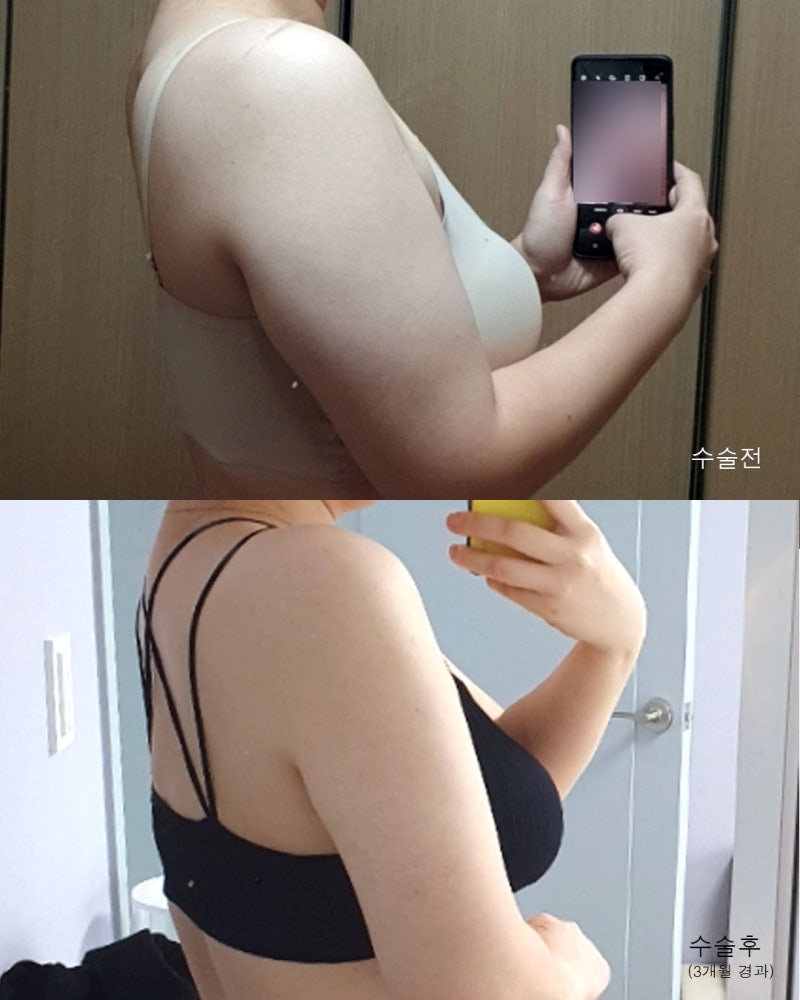 팔지방흡입 전후와 흉터회복과정 사진 3
