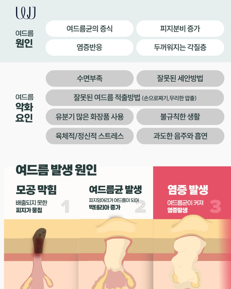 재발하는 여드름 원인과 피부과 레이저 치료방법 사진 3