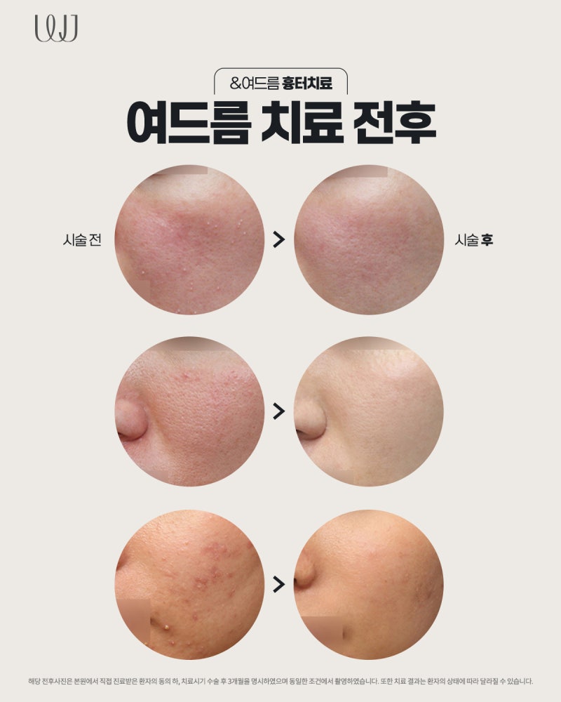 재발하는 여드름 원인과 피부과 레이저 치료방법