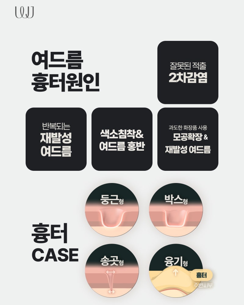 재발하는 여드름 원인과 피부과 레이저 치료방법 사진 5