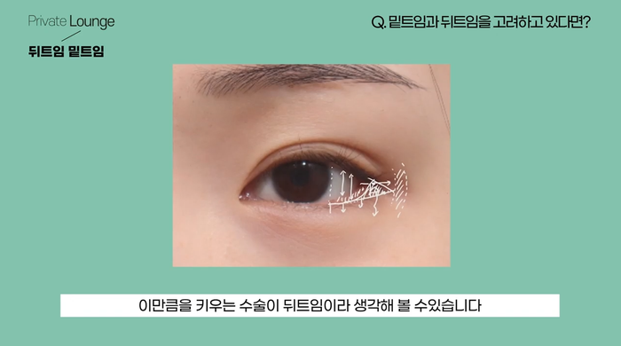 Private Plastic Surgery: Lateral Canthoplasty & Lower Canthoplasty with Director Lee Jun-woo 사진 9