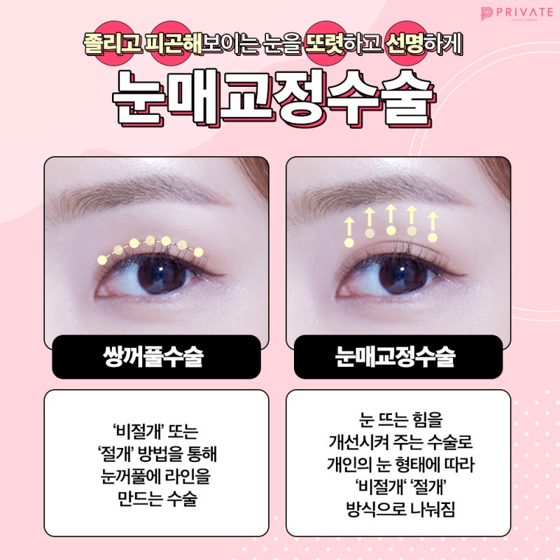 Ptosis Correction at Private Plastic Surgery 사진 4