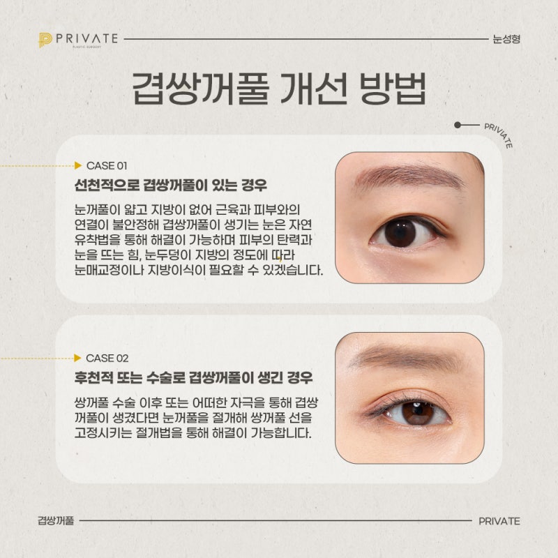 Learn About Double Eyelid Surgery at Private Plastic Surgery Clinic 사진 4