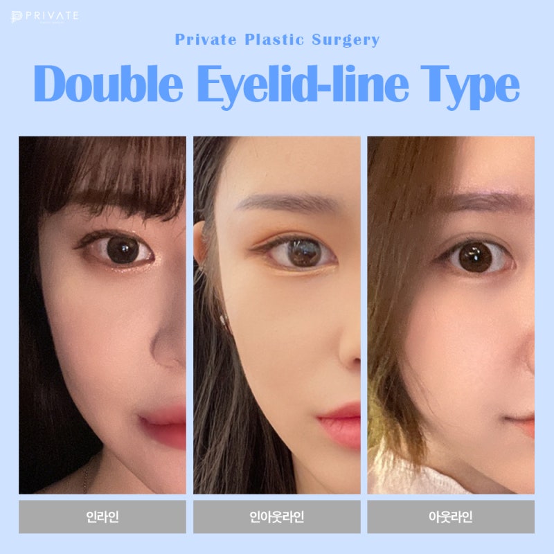 Sinsa Private Plastic Surgery: Renowned for Eye Reoperation 사진 5