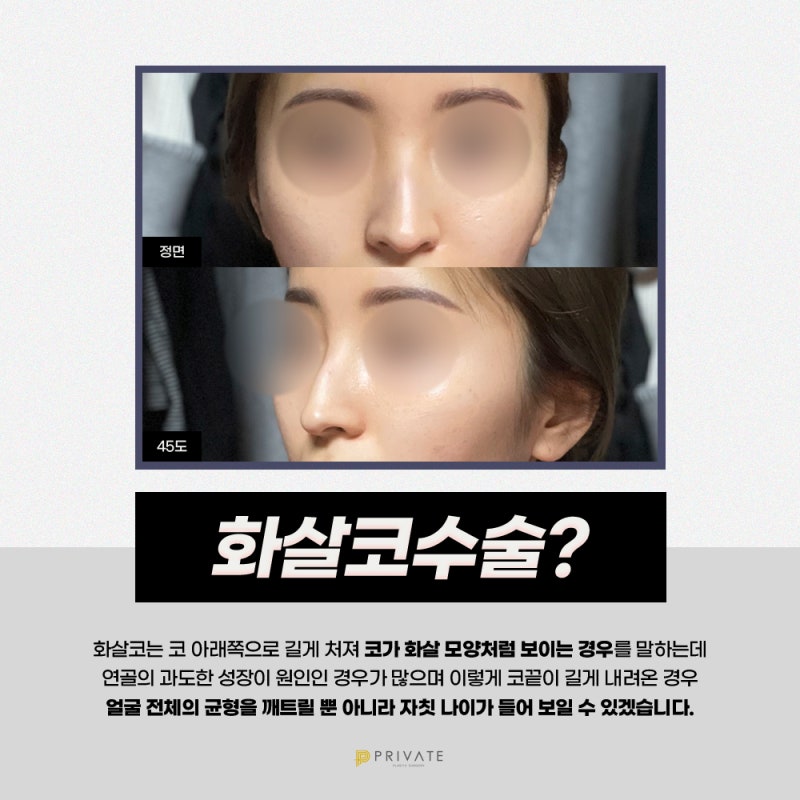 Arrowhead Nose Surgery at Sinsa Private Plastic Surgery Clinic