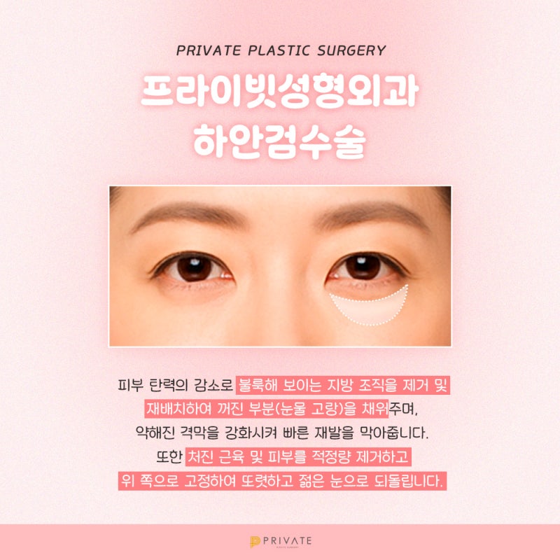 하안검수술잘하는병원 프라이빗성형외과
