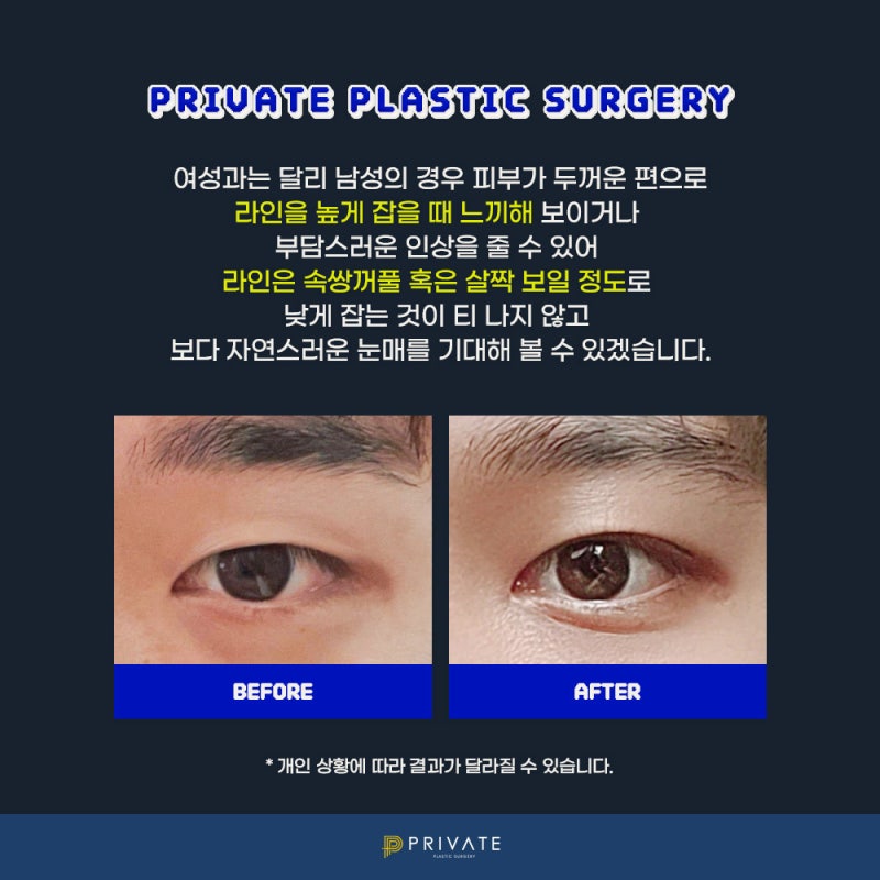 โรงพยาบาลทำตาสองชั้นสำหรับผู้ชาย: Private Plastic Surgery Clinic ในชินซา