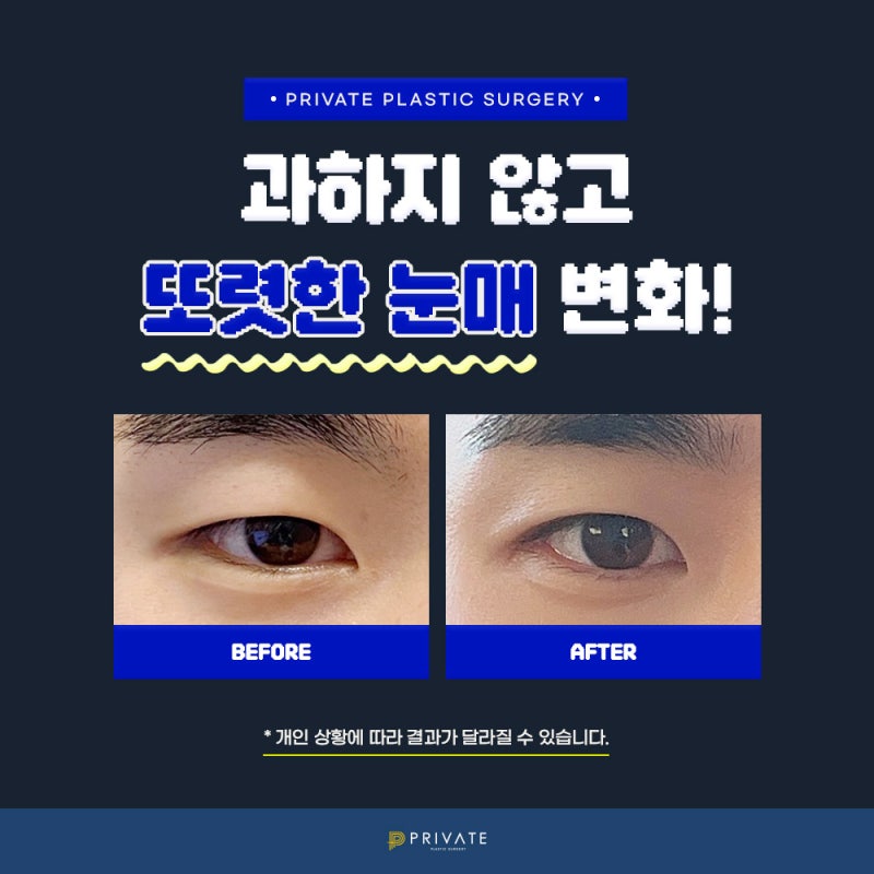 โรงพยาบาลทำตาสองชั้นสำหรับผู้ชาย: Private Plastic Surgery Clinic ในชินซา 사진 5