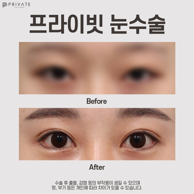 Semi-Outline Double Eyelid Surgery at Private Plastic Surgery Clinic 사진 7