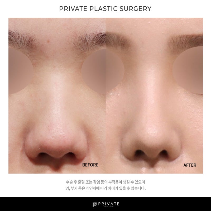 Penasaran dengan ulasan operasi hidung bengkak di Private Plastic Surgery 사진 9