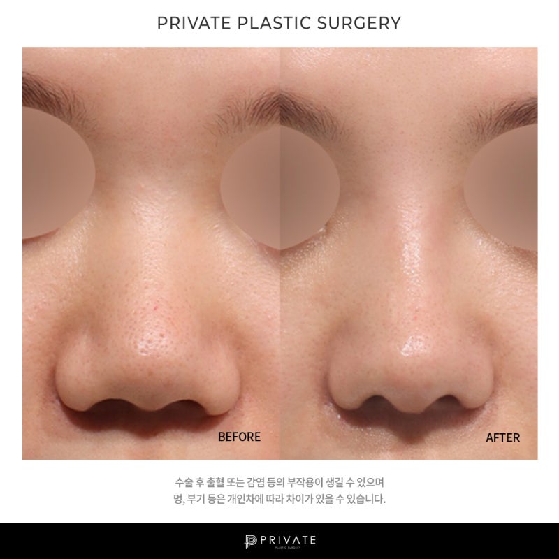 Penasaran dengan ulasan operasi hidung bengkak di Private Plastic Surgery 사진 10