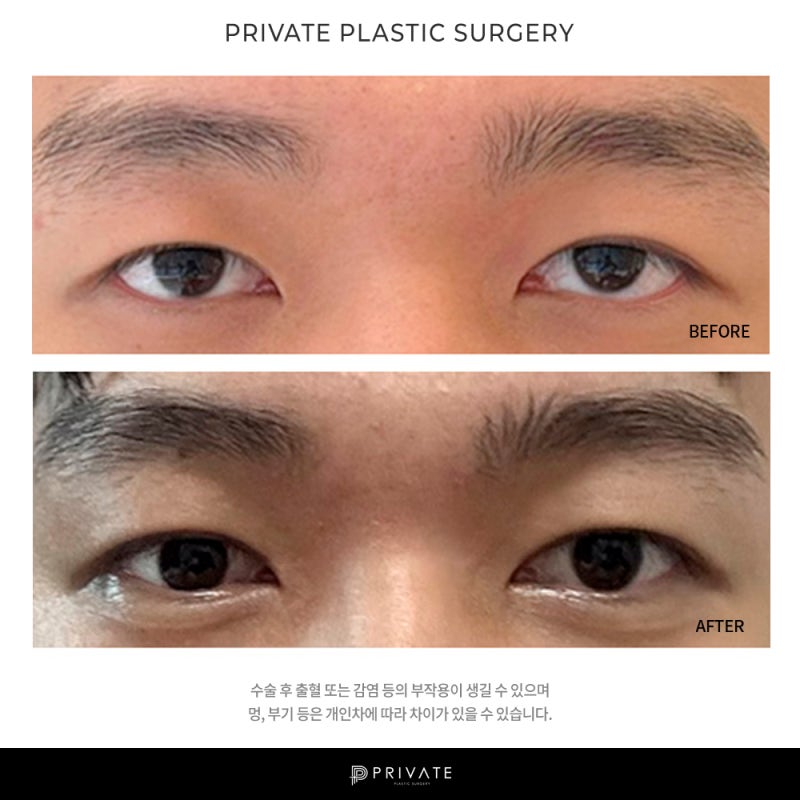 Private Plastic Surgery, Rumah Sakit Bedah Mata Pria yang Unggul 사진 7