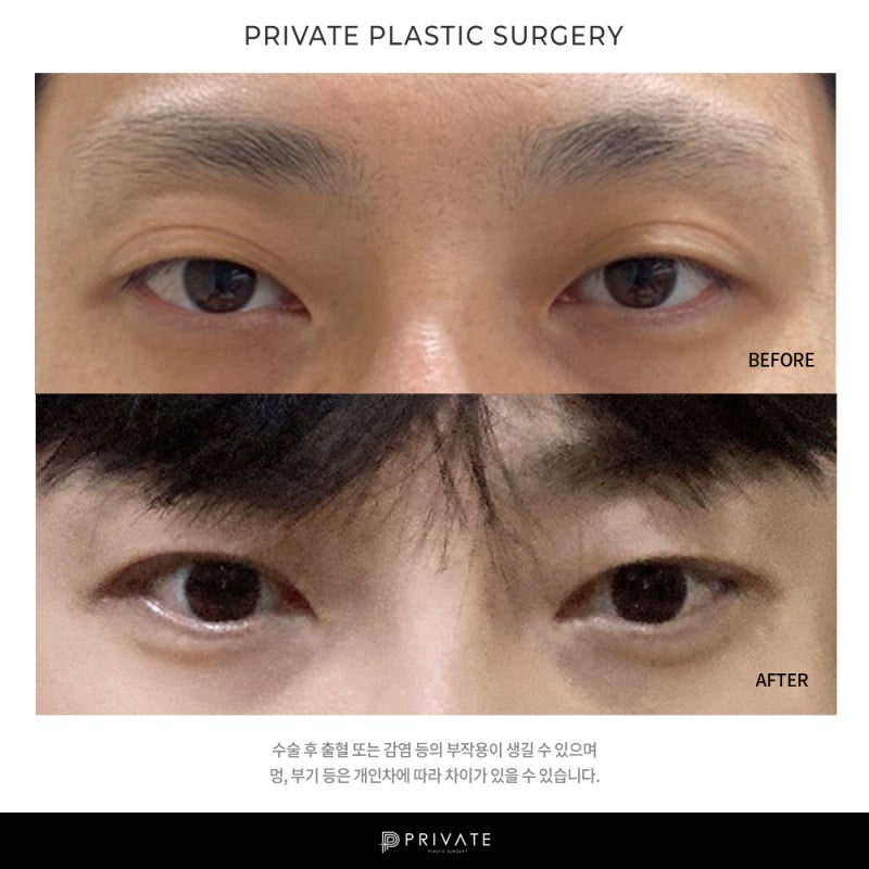 Private Plastic Surgery, Rumah Sakit Bedah Mata Pria yang Unggul 사진 6