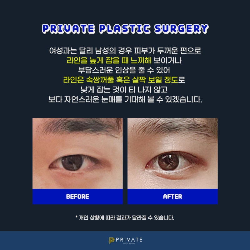 Private Plastic Surgery, Rumah Sakit Bedah Mata Pria yang Unggul