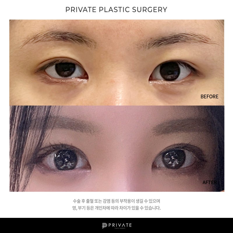 Ingin Tahu Hasil Operasi Koreksi Mata di Private Plastic Surgery? 사진 8