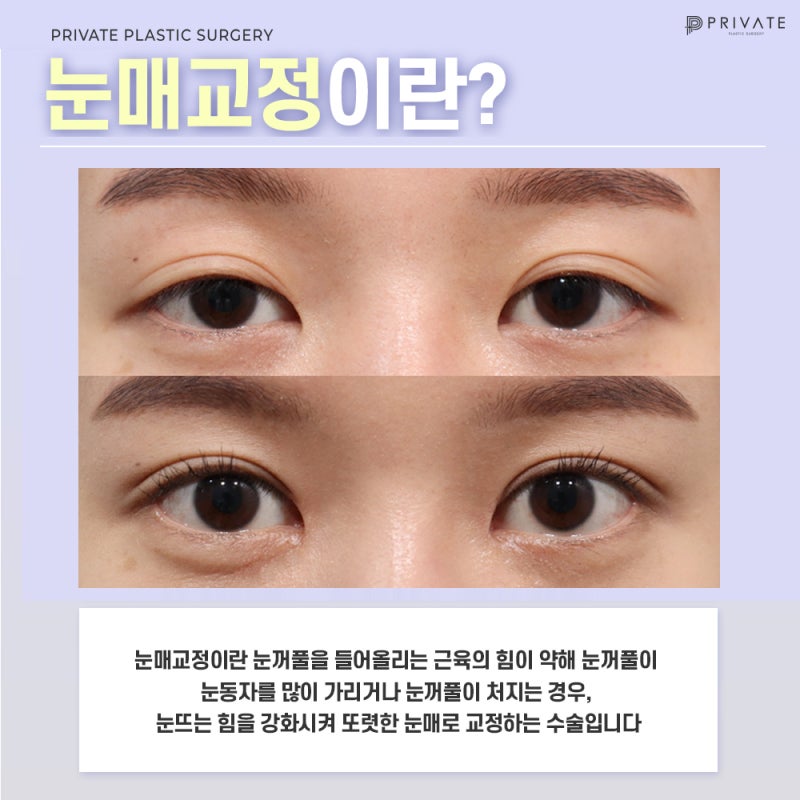 Ingin Tahu Hasil Operasi Koreksi Mata di Private Plastic Surgery?