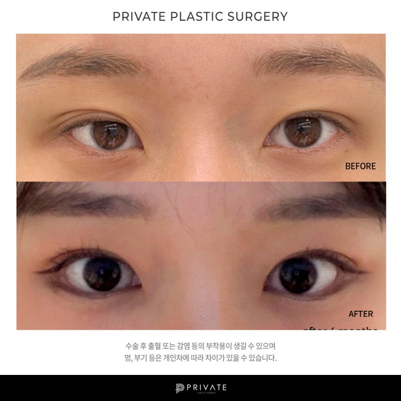 Ingin Tahu Hasil Operasi Koreksi Mata di Private Plastic Surgery? 사진 7
