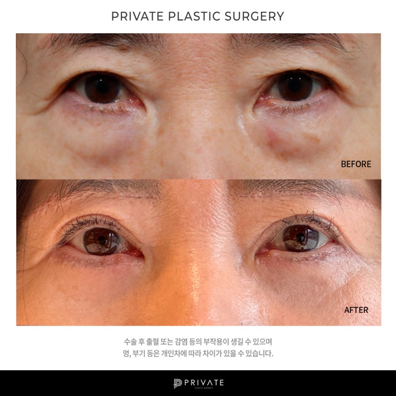 Sinsa Private Plastic Surgery: The Best Place for Lower Blepharoplasty 사진 7