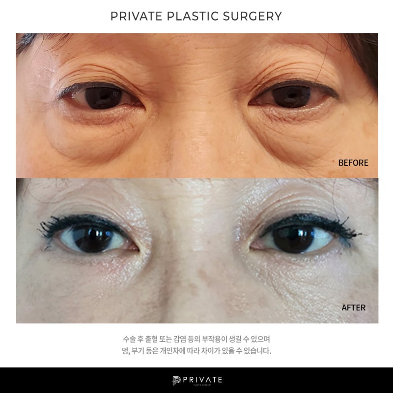 Sinsa Private Plastic Surgery: The Best Place for Lower Blepharoplasty 사진 8