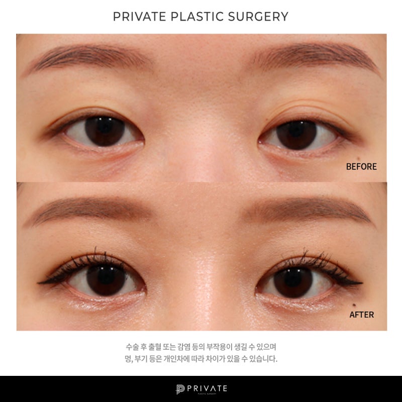 Private Plastic Surgery Clinic, Incisional Double Eyelid Surgery 사진 8