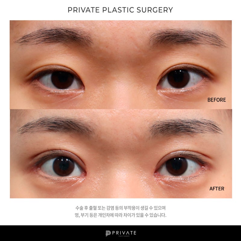 Private Plastic Surgery Clinic, Incisional Double Eyelid Surgery 사진 7