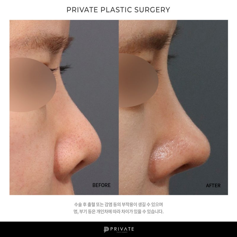 Private Plastic Surgery: Why Short Nose Surgery Reviews Are Good 사진 7