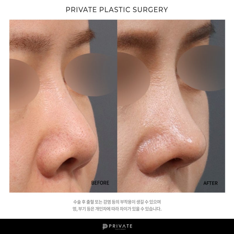 Private Plastic Surgery: Why Short Nose Surgery Reviews Are Good 사진 8