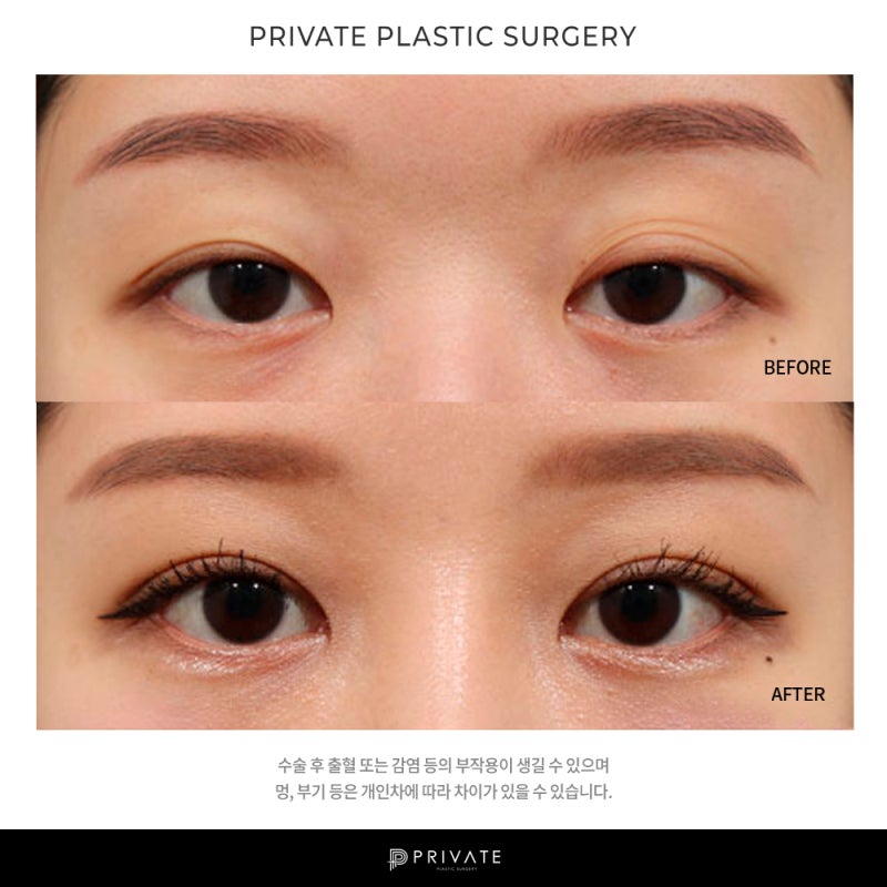 Отзывы о блефаропластике в Private Plastic Surgery? 사진 8