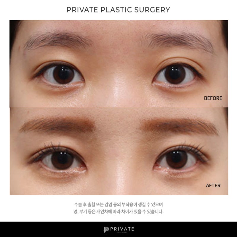 Отзывы о блефаропластике в Private Plastic Surgery? 사진 7