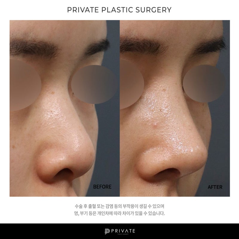Private Plastic Surgery Clinic ที่มีรีวิวการเสริมจมูกทรงต่ำที่ดี 사진 8