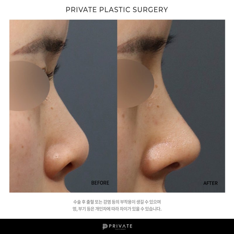 Private Plastic Surgery Clinic ที่มีรีวิวการเสริมจมูกทรงต่ำที่ดี 사진 7