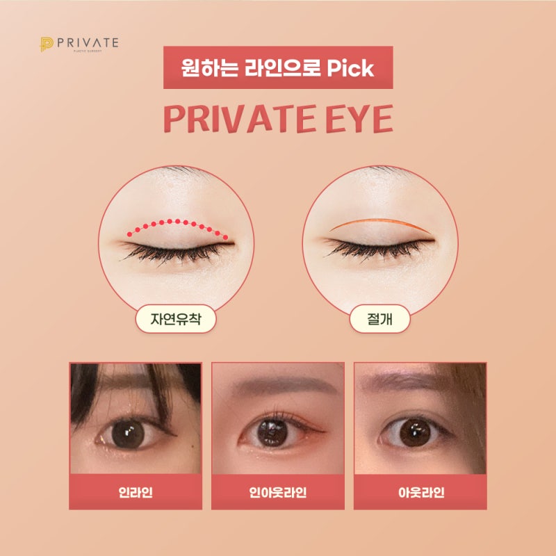 Private Plastic Surgery Clinic: Eye Reoperation Cases 사진 3