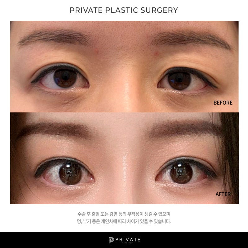 Private Plastic Surgery Clinic: Eye Reoperation Cases 사진 7