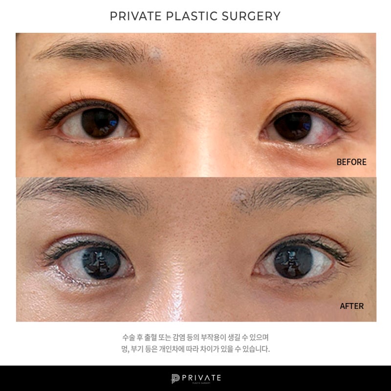 Private Plastic Surgery Clinic: Eye Reoperation Cases 사진 8
