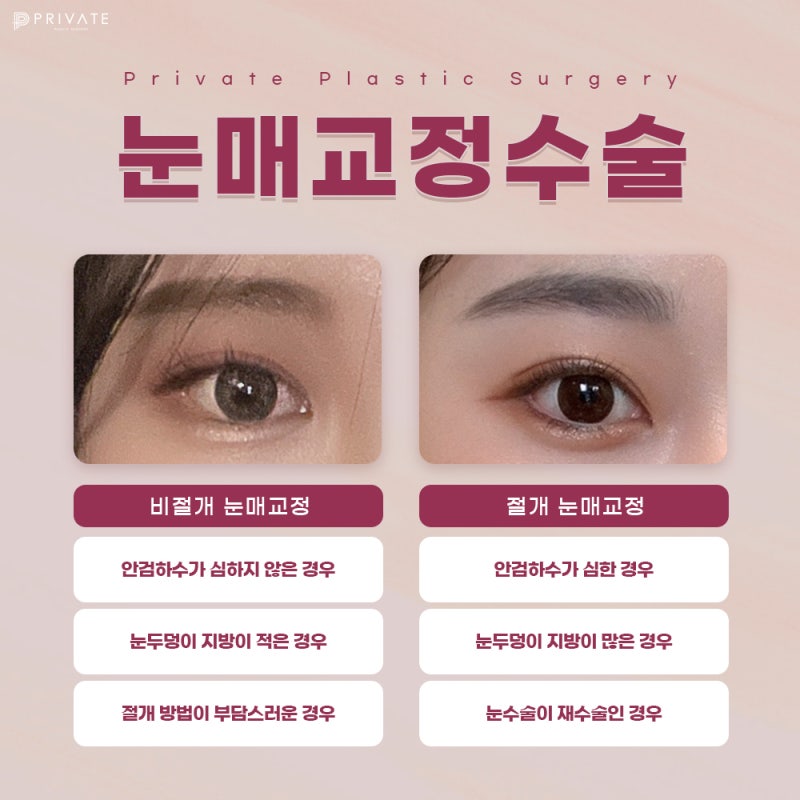 Sinsa Eye Surgery: Ptosis Correction for Clearer Eyes 사진 6