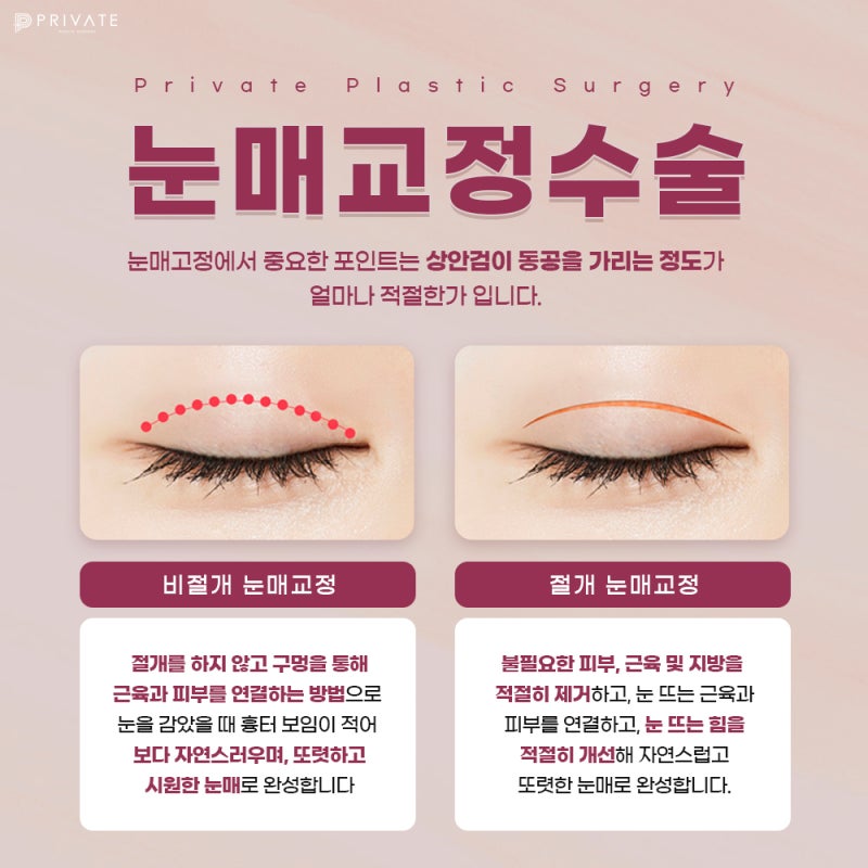 Sinsa Eye Surgery: Ptosis Correction for Clearer Eyes 사진 5
